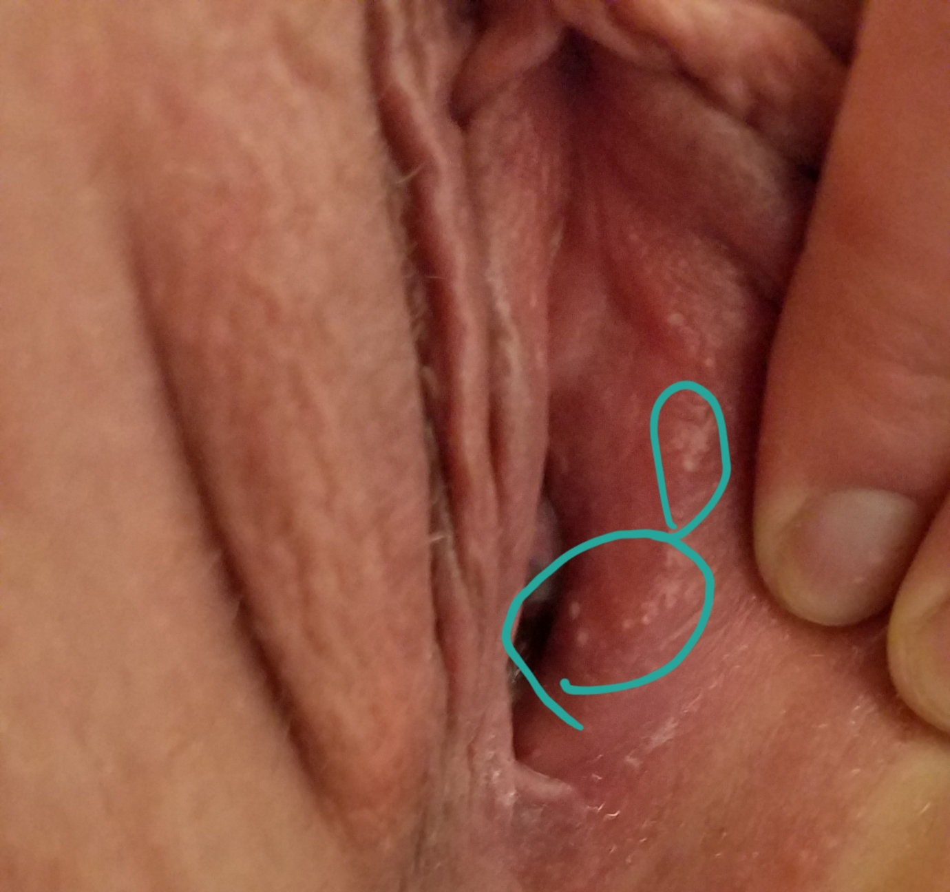 чем можно заразится сифилисом при мастурбации фото 114