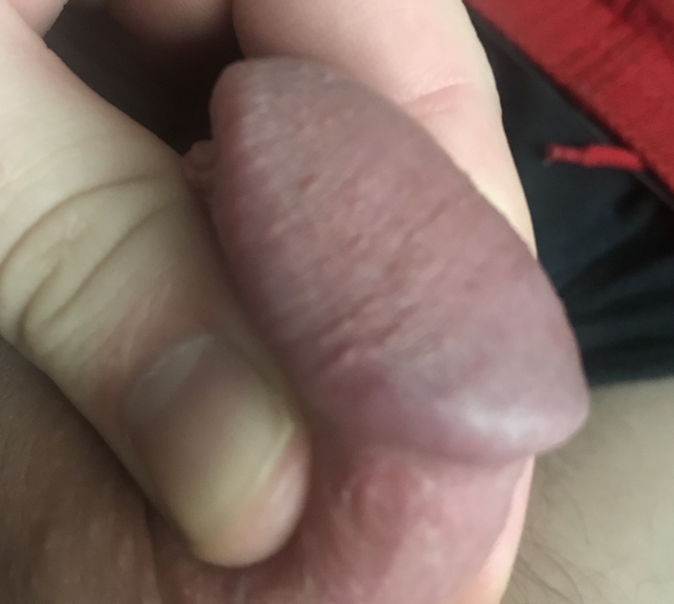 Blood blisters near vagina