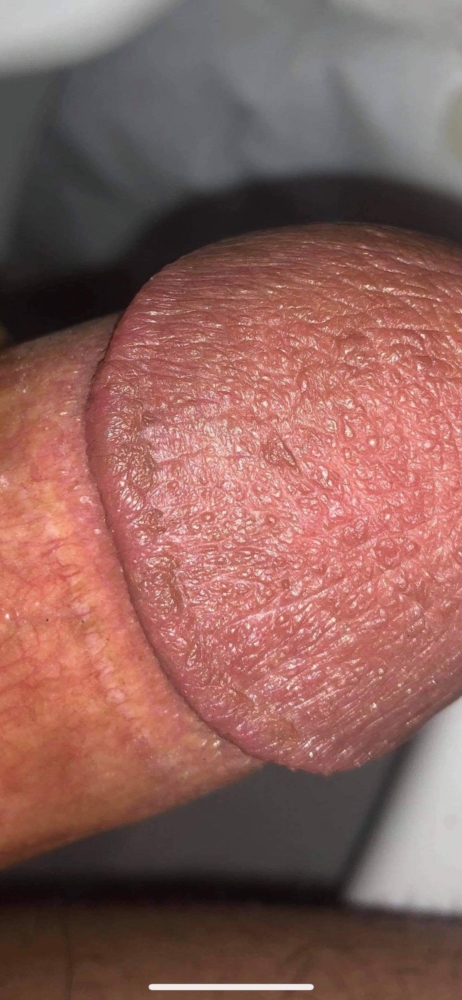 HPV Warts Discoloration And Brown Patches On Glans Penis Disorders