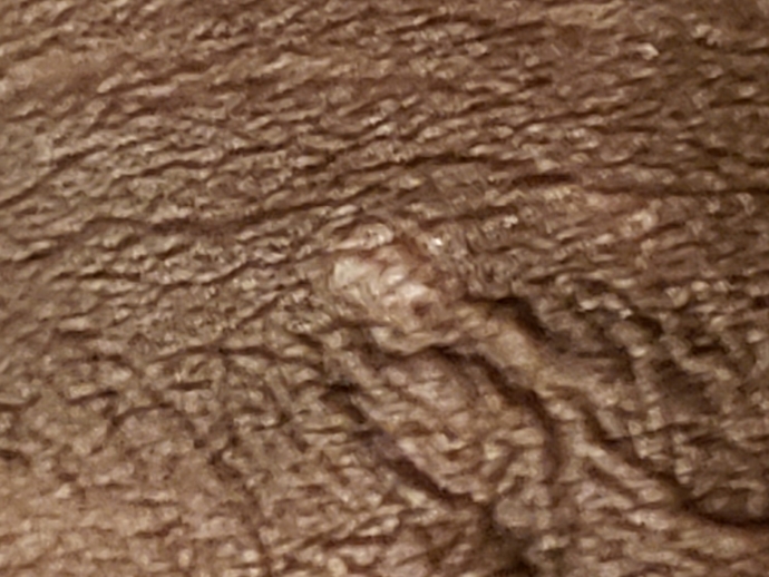 penis pimples shaft