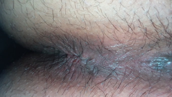 Herpes After All Genital Herpes Simplex Forums Patient