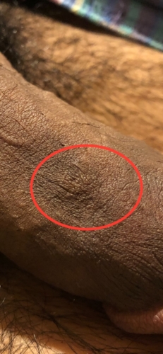Does This Look Like Genital Warts Please Help Sexual