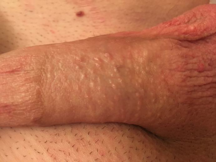 Is This Just A Case Of Fordyce Spots Penis Disorders Forums Patient