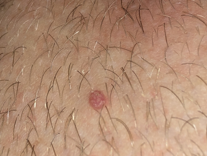 Genital Wart or normal infection of the hair follicule? | Sexual Health