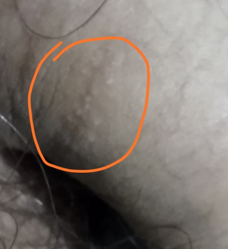 Small Bumps On Shaft Sexual Health Forums Patient.