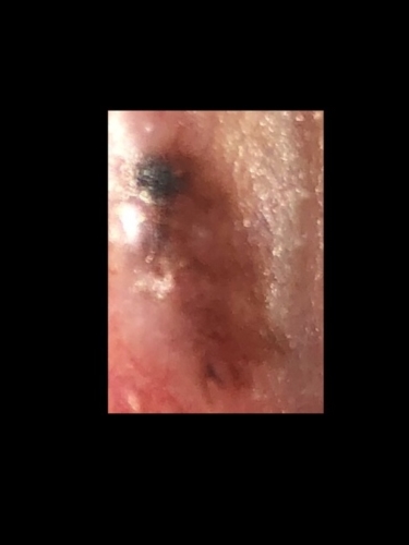 Does this look like vulvar melanoma? | Vulval Problems | Forums | Patient
