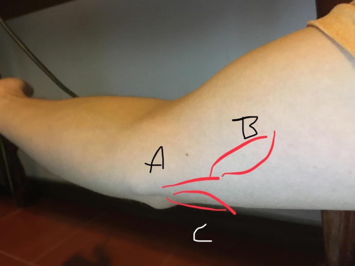 Elbow pain behind medial epicondyle extending to upper arm muscles