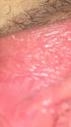 I M Scared I Don T Know What These Bumps Are Hpv Sexual