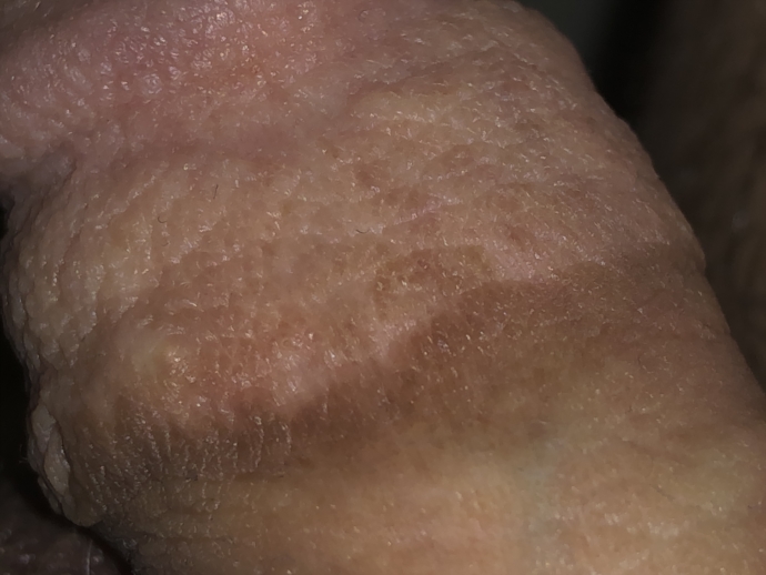 Is This Herpes Please Read And Help Genital Herpes Simplex Forums Patient