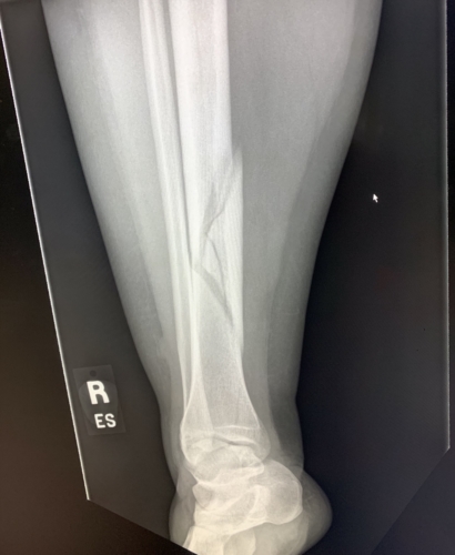 Trimalleolar Fracture | Ankle Problems | Forums | Patient