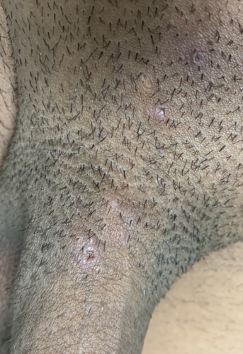 Help, Need insight on what this could be!? | Genital Herpes Simplex