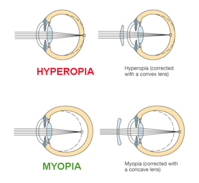 Choosing new lens with explantation of Panoptix. | Cataract | Forums