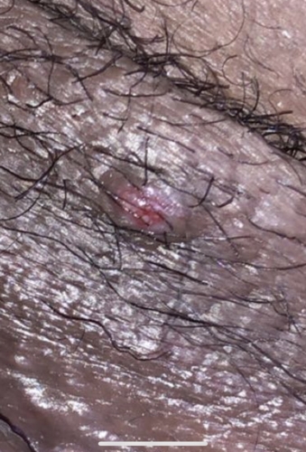 Bump Near Vagina Help Please [warning Graphic Image ] Sexual