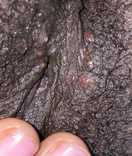 Is This Herpes I Haven T Had Sex In 2 Years Genital