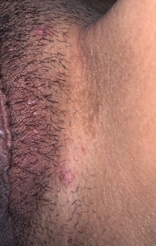 PLEASE HELP - are these genital warts? mixed diagnosis | Sexual Health