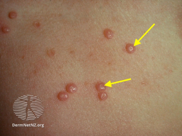 Are these hpv warts? Sexual Health Forums Patient