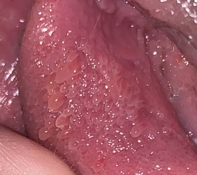 Vestibular papillomatosis bleeding
