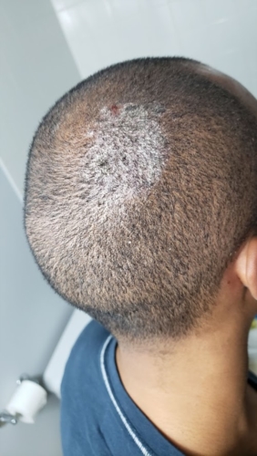 Itchy, Flaking, White Spots on Scalp | Dermatology | Forums | Patient