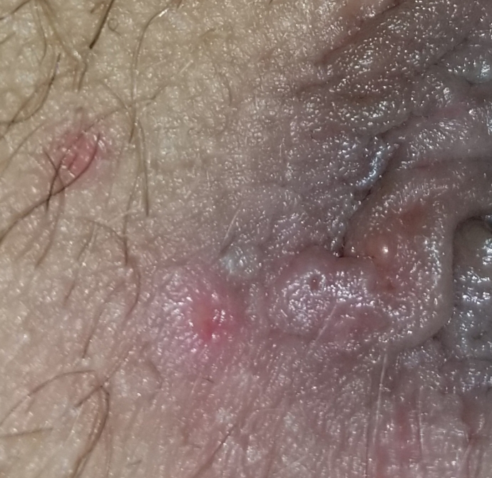 690 x 671 - jpeg. herpes im worried genital herpes simplex forums patient. 