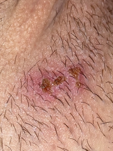 Help Please Is This Herpes Photo In