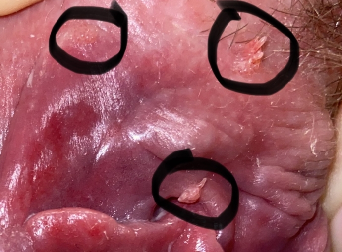 Clitoris hood piercing pain