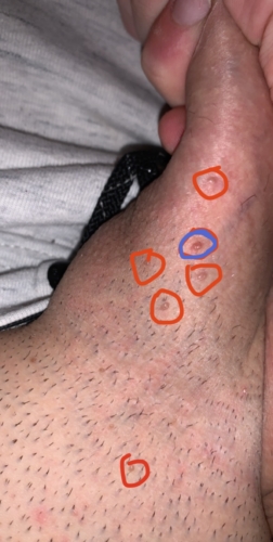 Are These Bumps Gentian Warts Sexual Health Forums