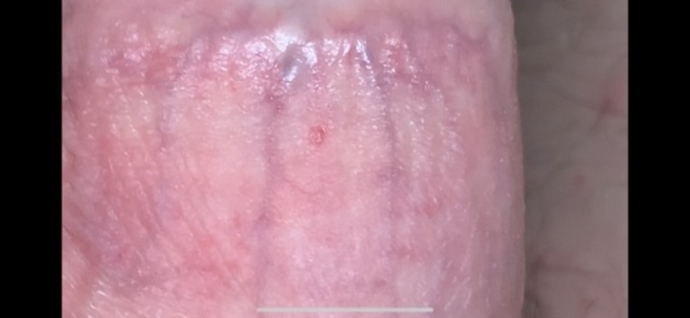 Fungle or warts?? Please help | Sexual Health | Forums | Patient