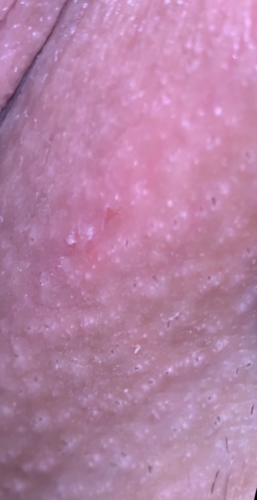 Could This Be Herpes Genital Herpes Simplex Forums Patient