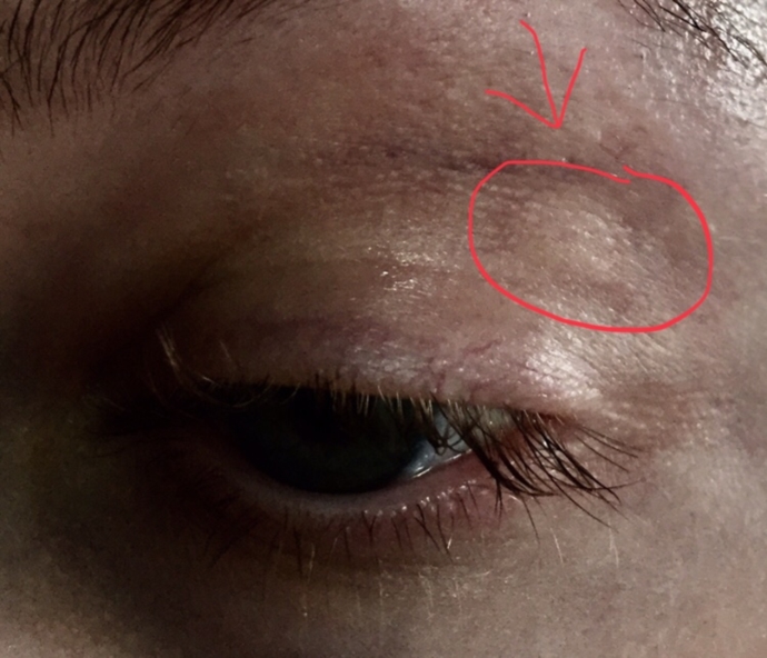 Weird thing on eyelid | Eye Problems | Forums | Patient