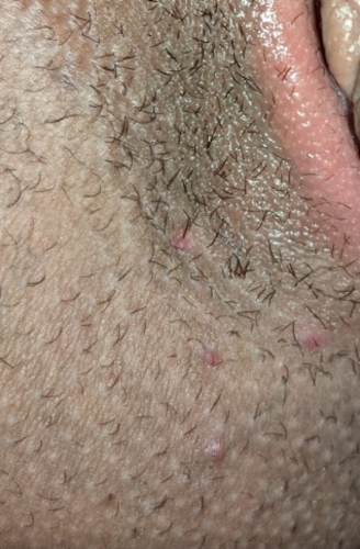 Does this look like Herpes, HPV, or ingrown hair? | Genital Herpes