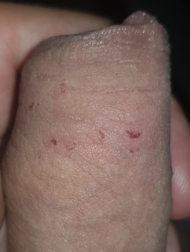 Help Multiple Lesions Suddenly Appeared On My Penis Are This Genital