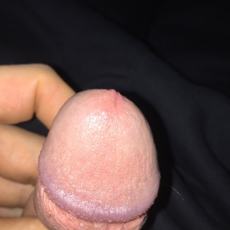 Very sensitive penis head, red, small bumps on head, not smooth or shiny. 