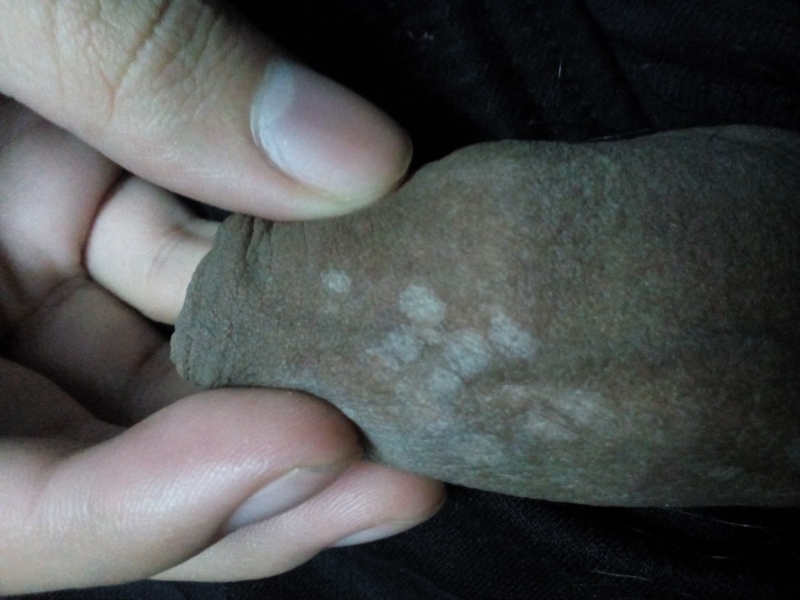 vitiligo pénisz)