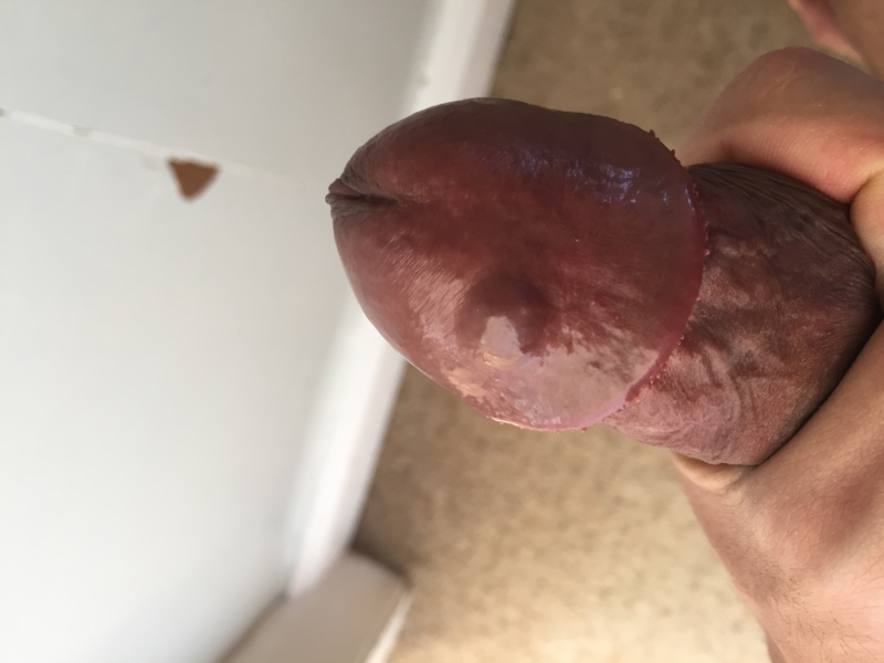 Pyogenic granuloma of the penisdon't squeeze them