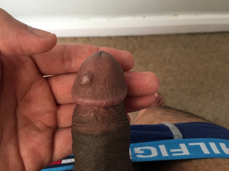 Red spots on penis no itching