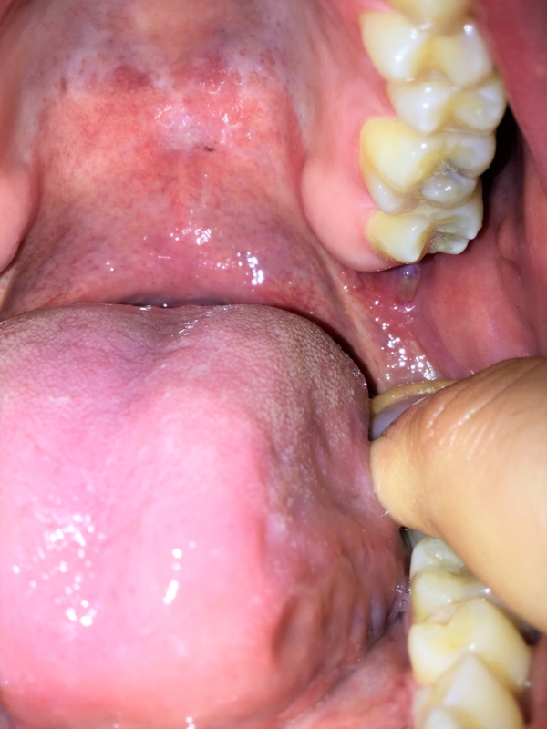 Roof Of Mouth Hurts When Swallowing 115