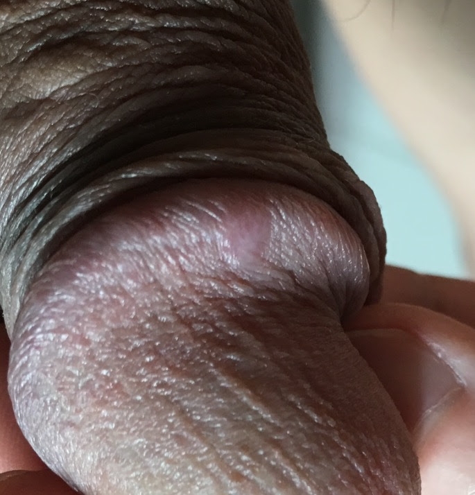 Tiny Raised Bump Under Penis Head