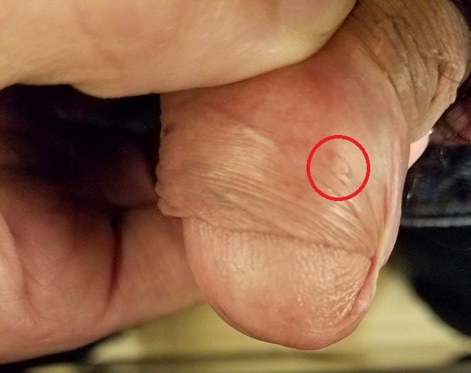 Doppler ultrasound of the penis