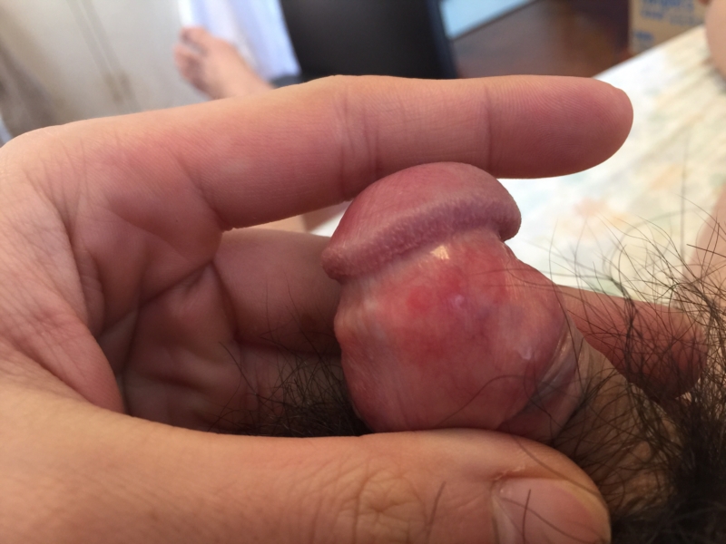 What Causes A Single Red Bump On The Penis