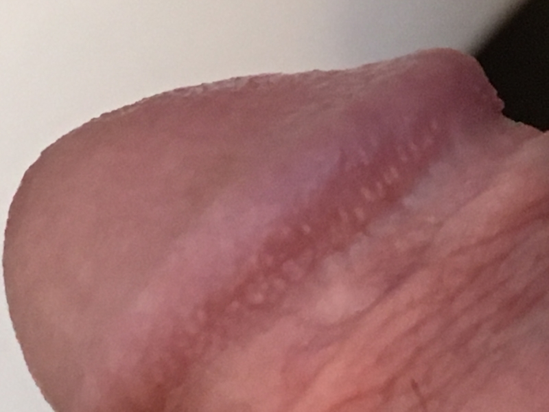 On small penis of bumps rim ​Pearly Penile