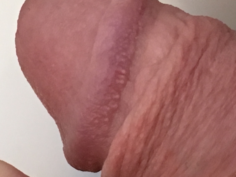 Bumps penis small of on rim Bumps on