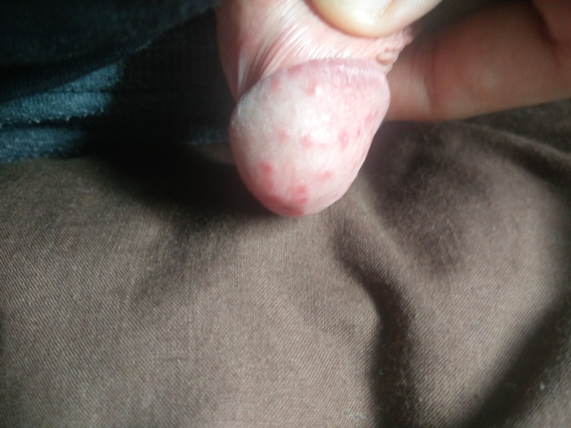 Small Red Dots On Head Of Penis 86