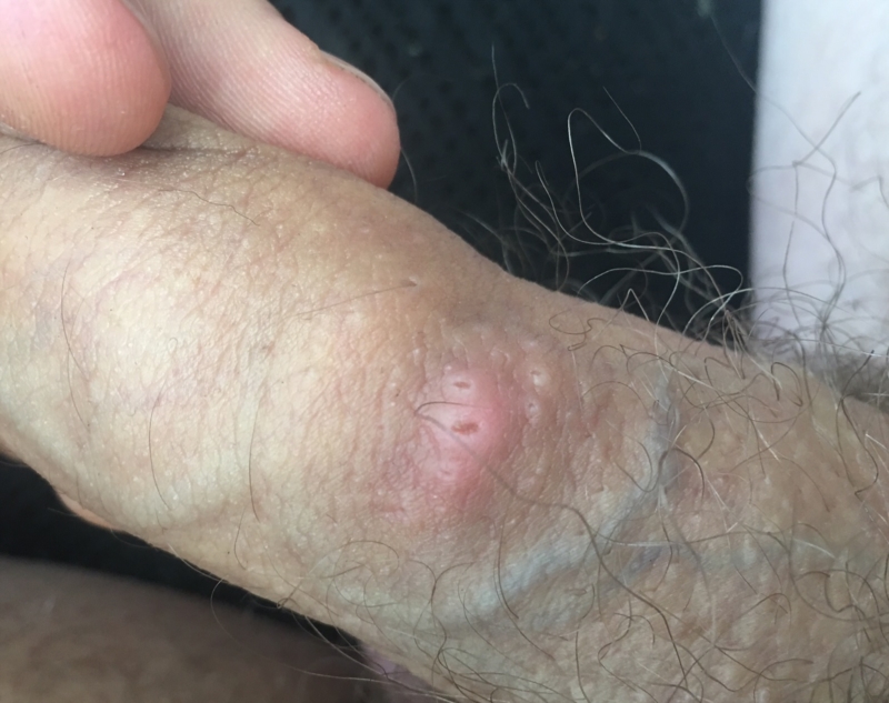 Skin Lesions On Penis 104