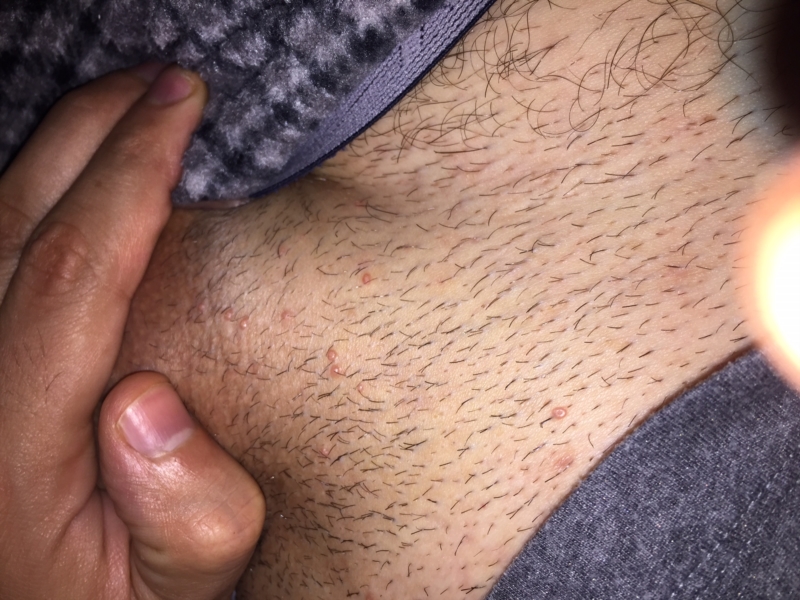 Itching After Sex In Groin Area.