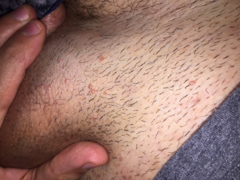 Can An Allergic Reaction Cause Bumps On Your Vagina 14