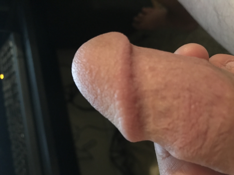 White Bump On Head Of Penis 12