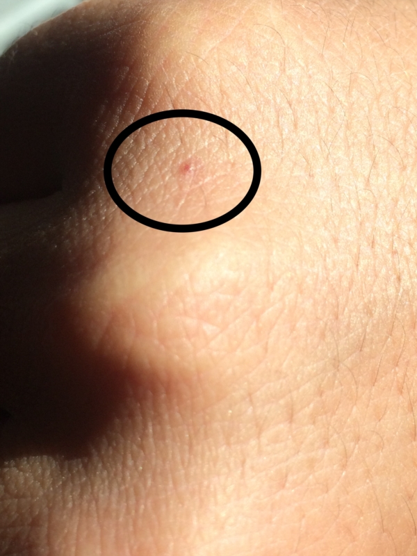 pinpoint red dots on skin defenciey