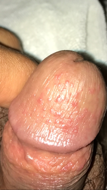 Red Bumps After Sex 17