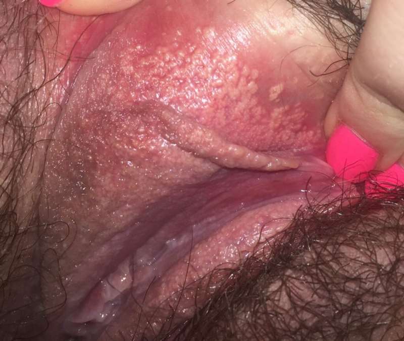 What Is Vaginal Acne