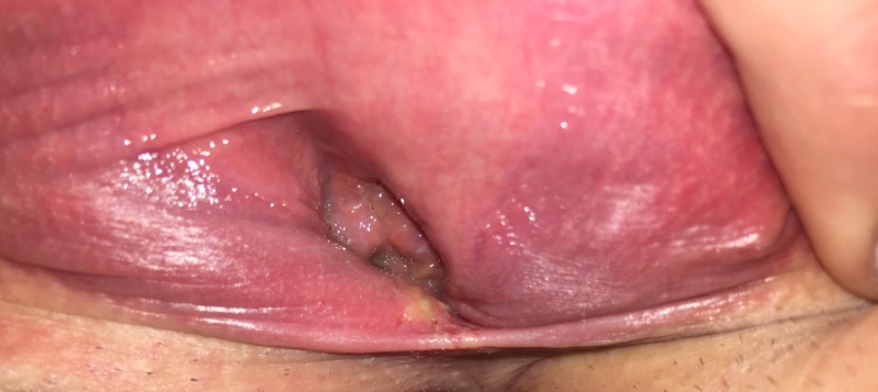 Pimple vaginal area